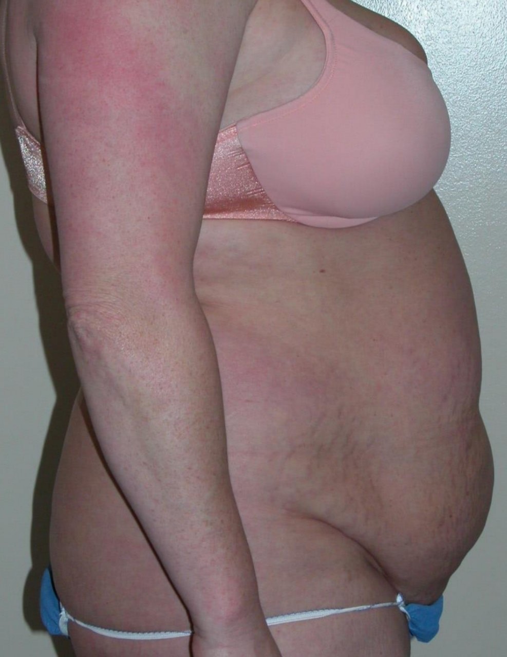 Before and after surgical result, Utah Aesthetic Surgery.