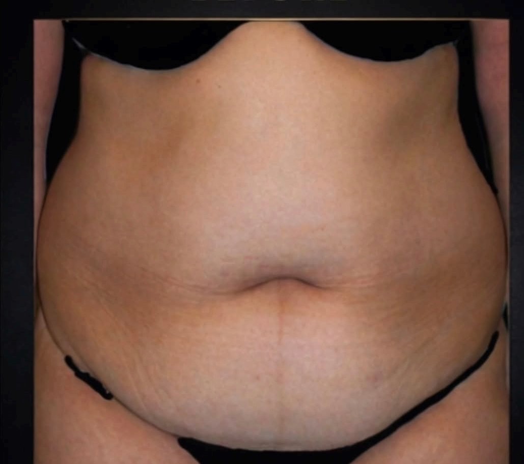 Before and after surgical result, Utah Aesthetic Surgery.