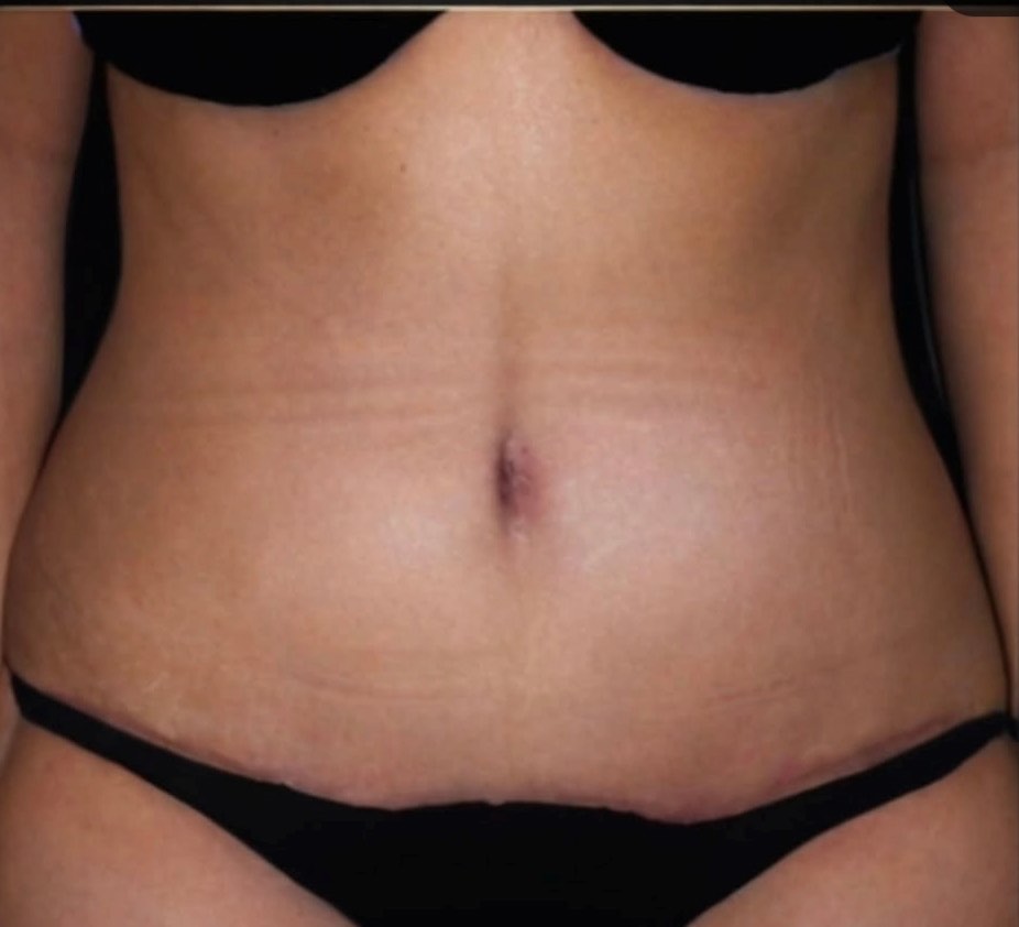 Before and after surgical result, Utah Aesthetic Surgery.