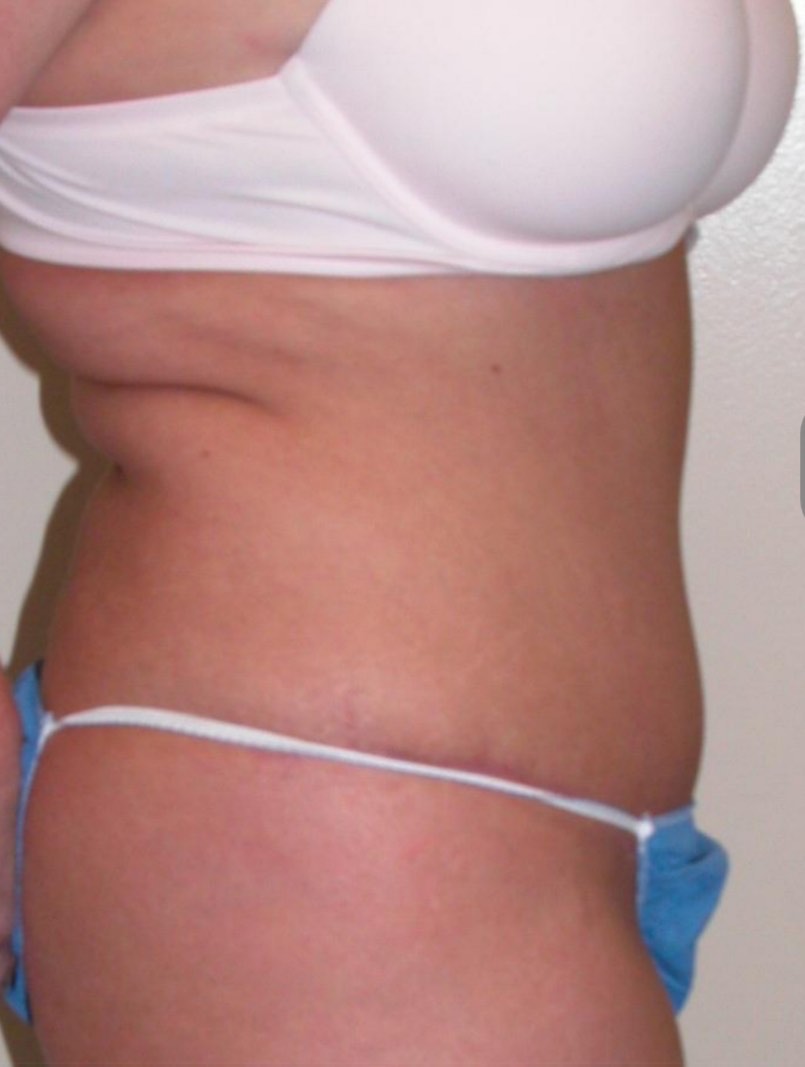 Before and after surgical result, Utah Aesthetic Surgery.